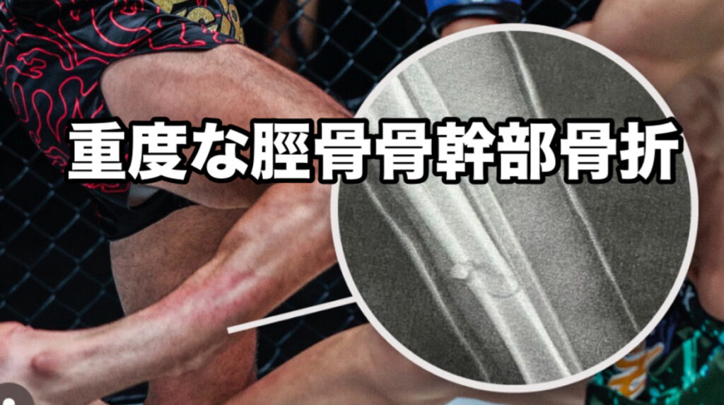 野杁正明、衝撃のONE初勝利！「カーフキック」で相手選手のスネを粉砕・骨折!!