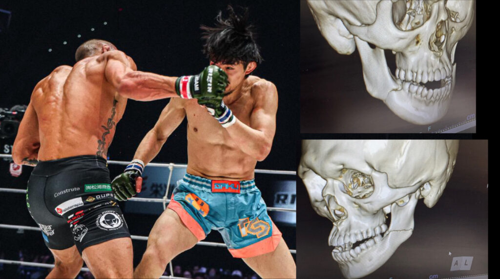 「両顎折れちまいました」桜庭大世選手 壮絶KO負けの代償を告白 レントゲン公開に衝撃「開いた口が塞がらない」